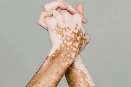 vitiligo vitiligo