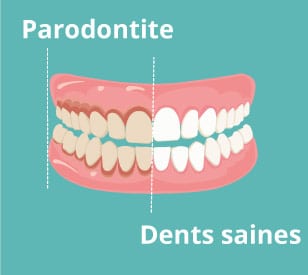 parodontite